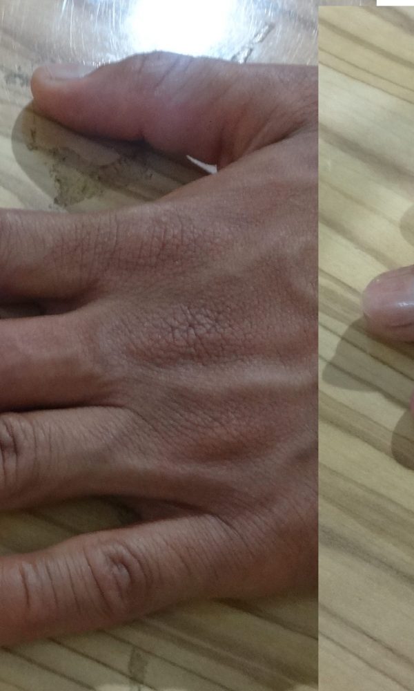 انگشت مصنوعی سیلیکونی