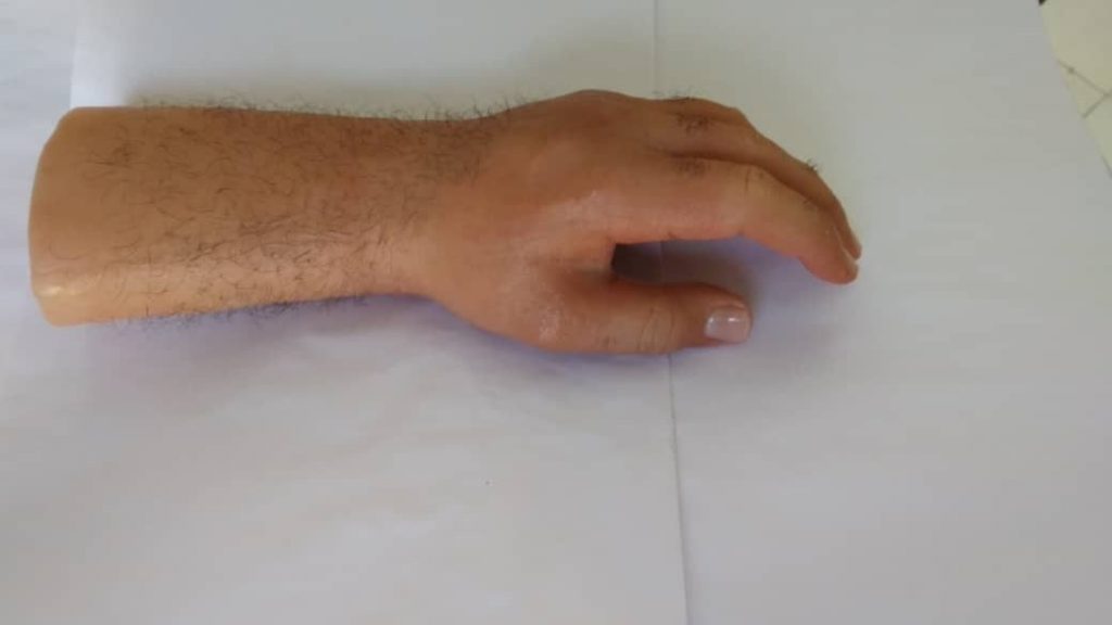 دست مصنوعی سیلیکونی (پروتز دست زیبایی)
