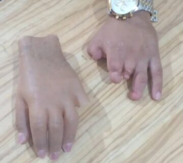 دست مصنوعی سیلیکونی(پروتز دست سیلیکونی)