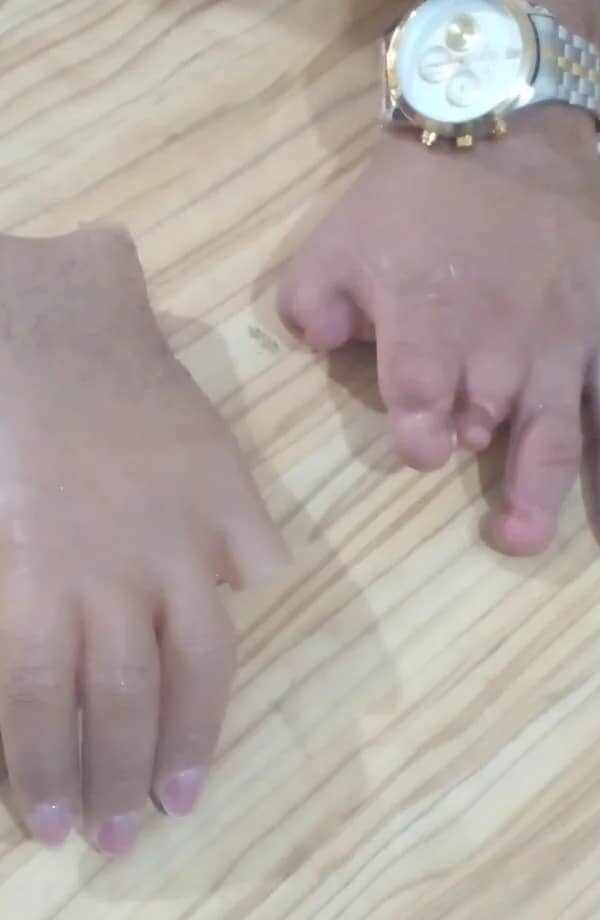 دست مصنوعی سیلیکونی(پروتز دست سیلیکونی)