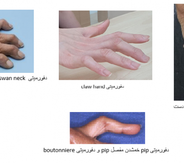 انحراف و خمیدگی انگشت دست
