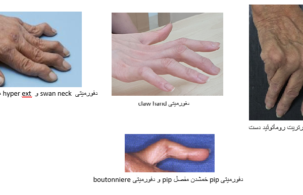 انحراف و خمیدگی انگشت دست